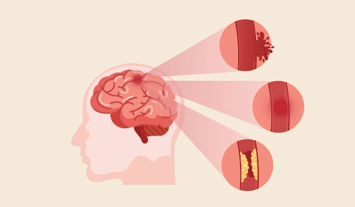 Everything you need to know about brain stroke